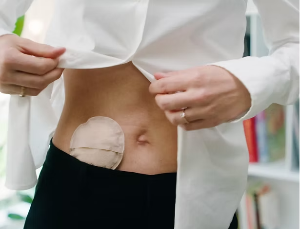 Fysisk prototype af produkt for Ampa Medical Medtech Stoma solution